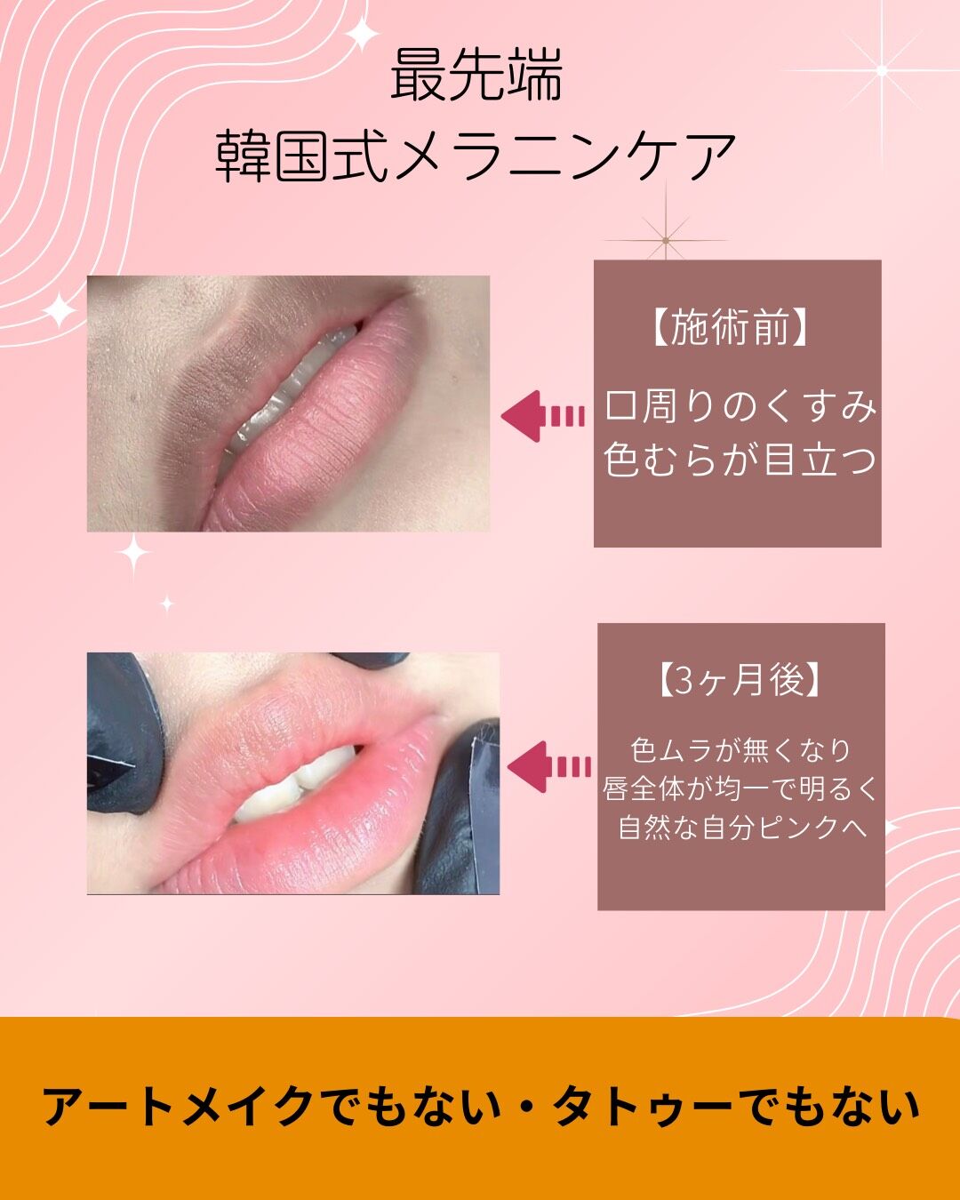 韓国式メラニンケア